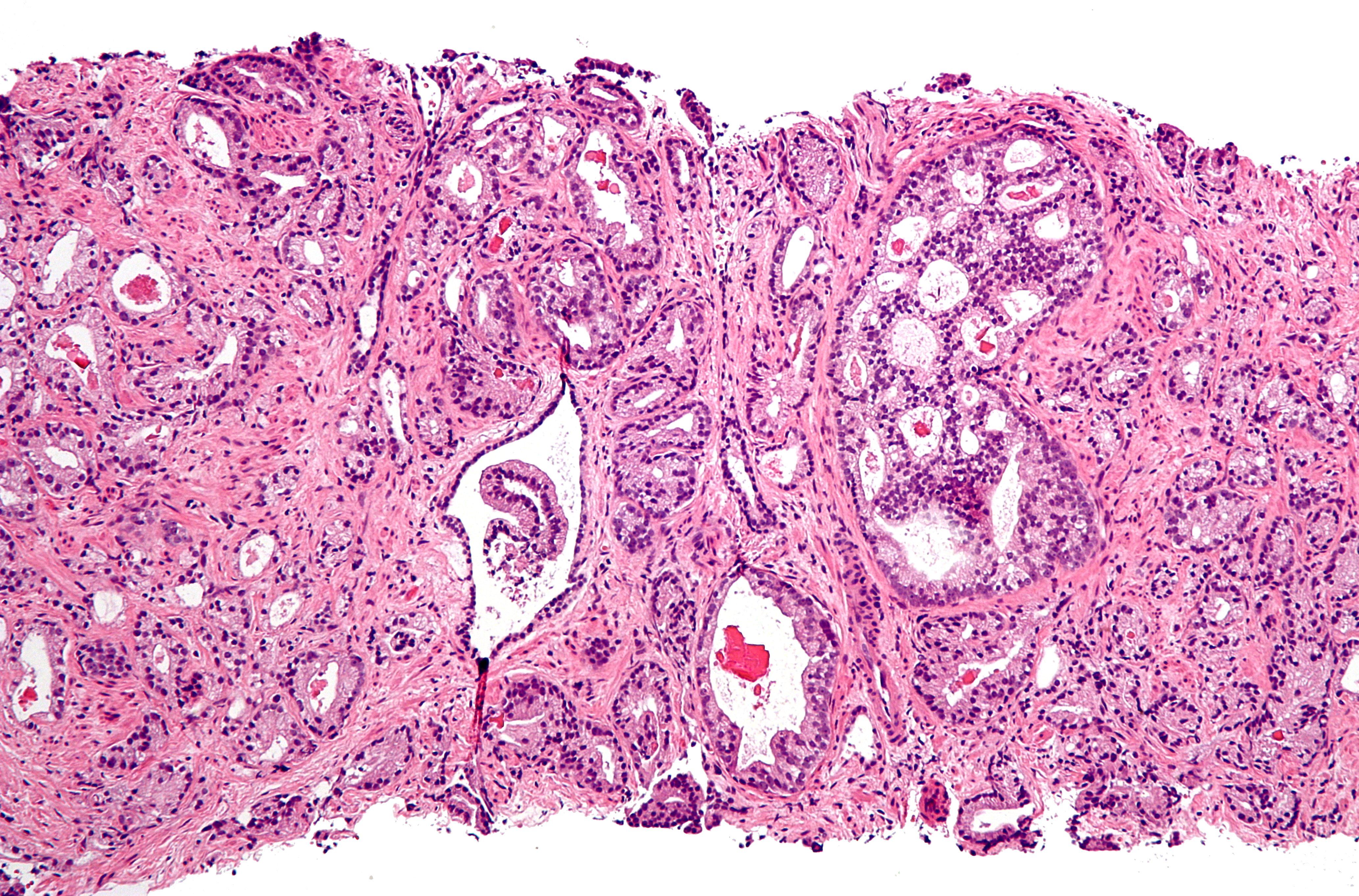 pec tac prostata