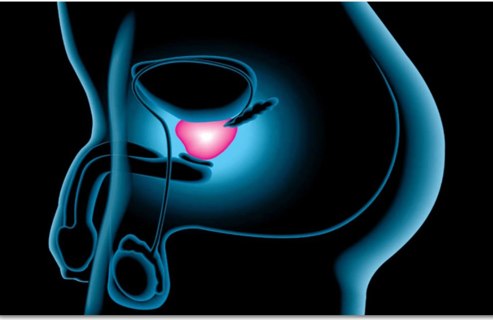 Cancer de prostata localizacion